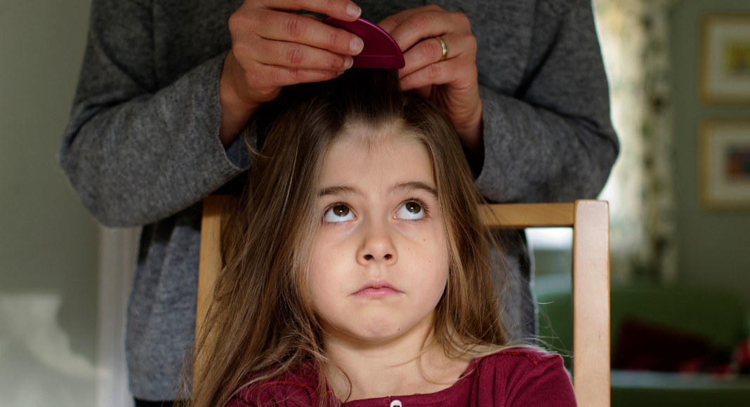 head lice 